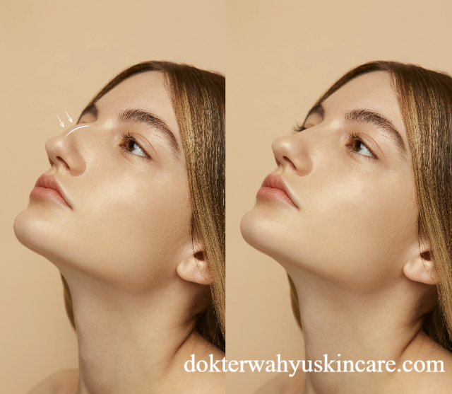 Tips Memilih 4 Jenis Operasi Hidung Sesuai Kebutuhan dan Fungsi